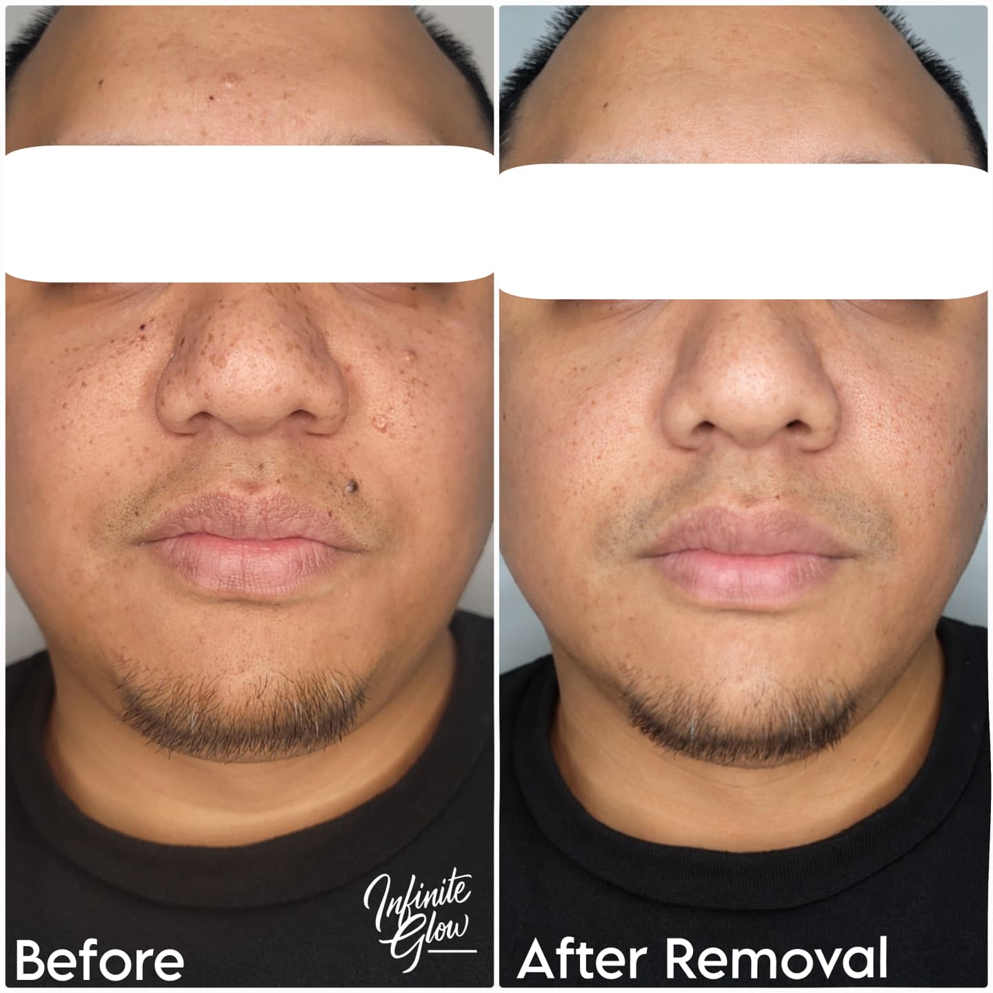 Infinite Glow client result 62